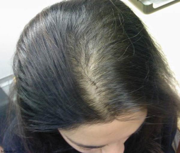 بررسی علل ریزش مو در زنان